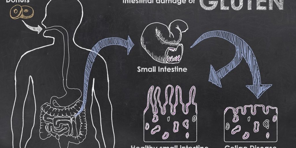 Intestinal Damage of Gluten Intestinal Damage of Gluten