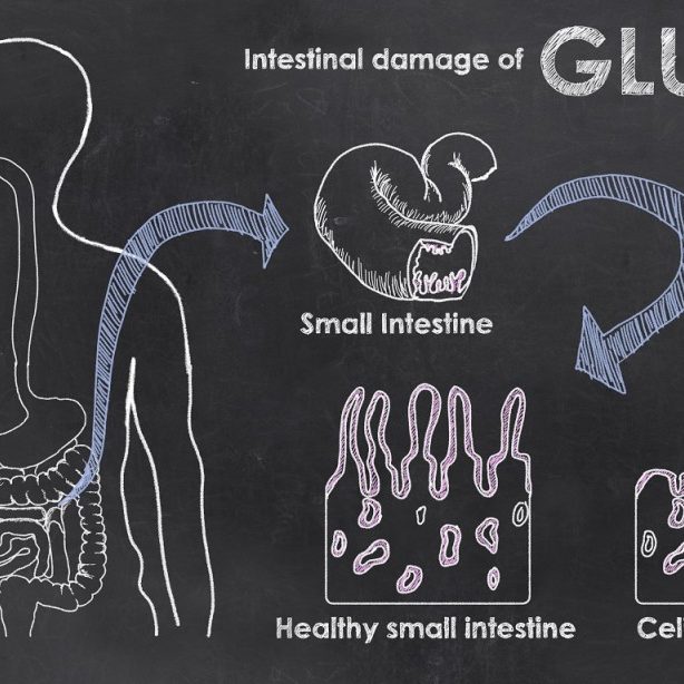 Intestinal Damage of Gluten Intestinal Damage of Gluten