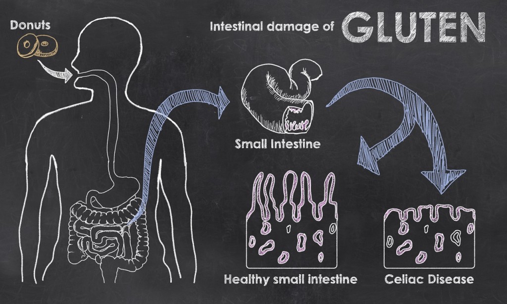 Intestinal Damage of Gluten Intestinal Damage of Gluten